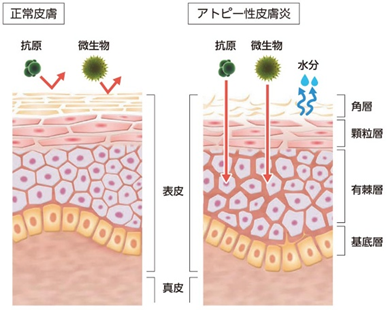 アトピー性皮膚炎の状態