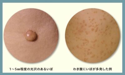 水いぼのアイキャッチ画像