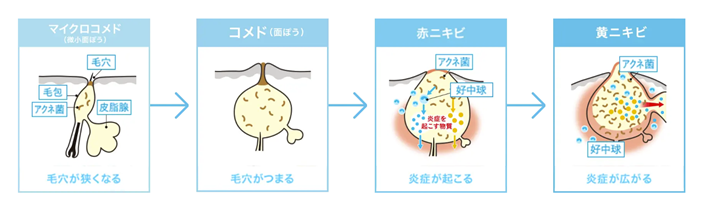 ニキビのお悩みのアイキャッチ画像